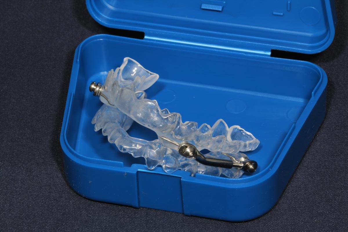 Schnarchtherapie-Schienen nach Prof. Dr. Hinz – Roß Dental Technik